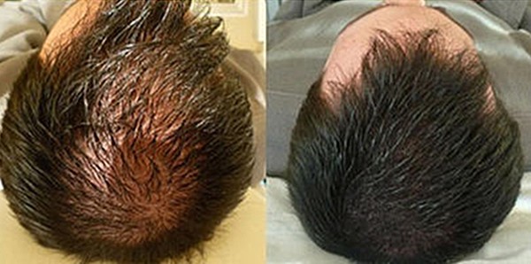 Scalp Micropigmentation FUR Man Hair