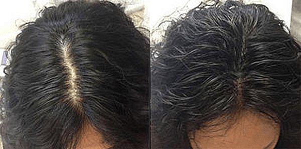 Scalp Micropigmentation FUR Woman Hair