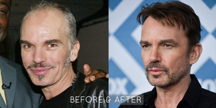 Billy Bob Thornton Hair Restoration