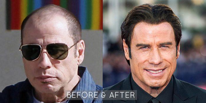 John Travolta Hair Restoration