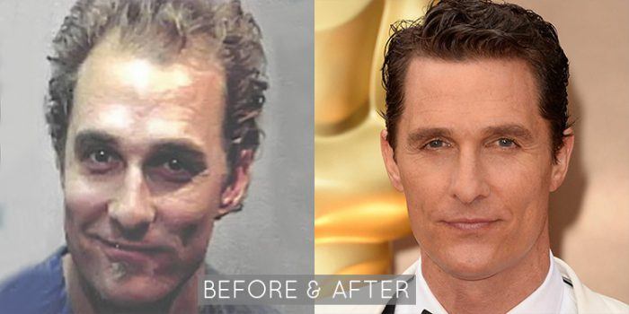 Matthew McConaughey Hair Restoration