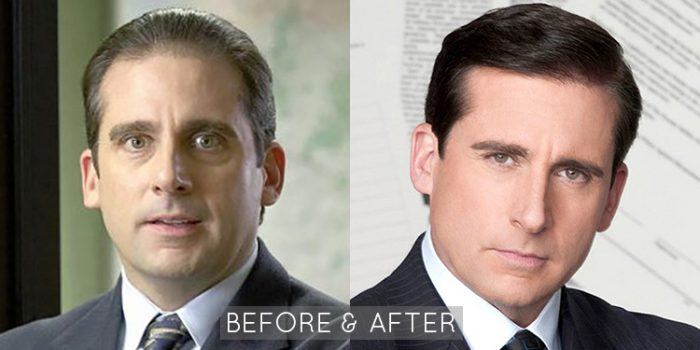 Steve Carell Hair Restoration